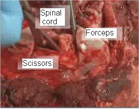 Figure 3 - Severing the attachments to free up the spinal cord. Description follows.